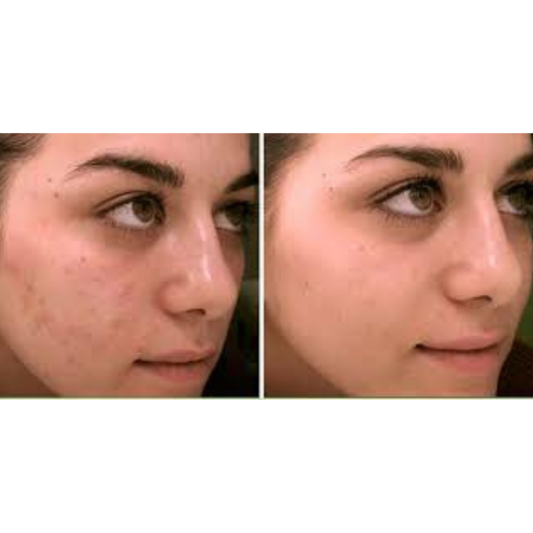 Kit Niacinamidasalicilicohialuronico